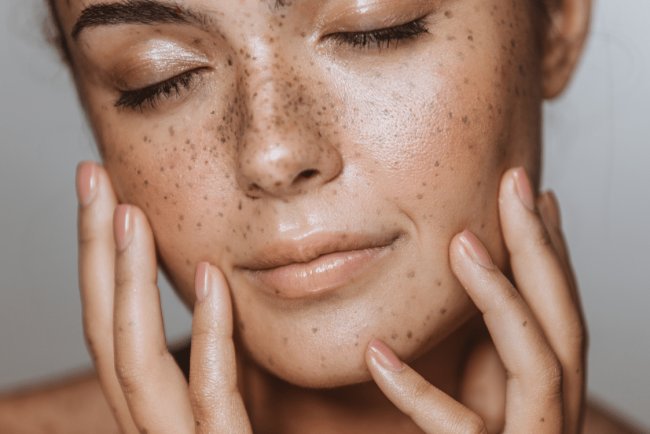 Having a hard time with hyperpigmentation? This Is Why Your Skincare Routine Should Include Tranexamic Acid