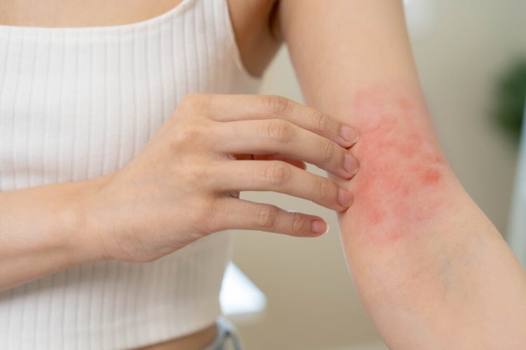 When Does a Drug Rash Go Beyond a Simple Itchy Problem? How to Recognize When to Be Concerned