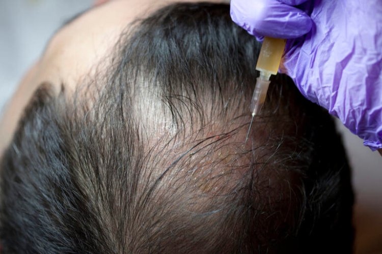 Platelet-Rich Plasma for Hair Loss: Could the Secret to Regrowth Be Flowing in Your Veins?