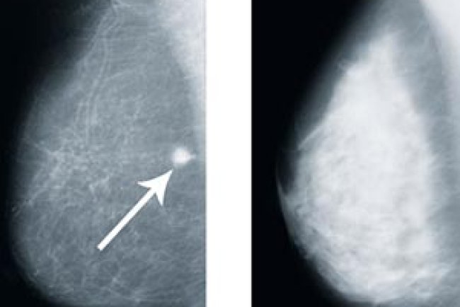 Dense Breasts on a Mammogram: What It Means and What You Can Do