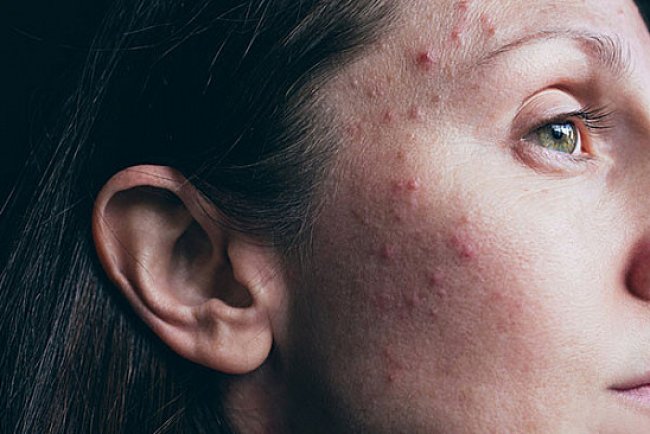 Adult Acne: Why It Happens and How to Finally Tame Breakouts