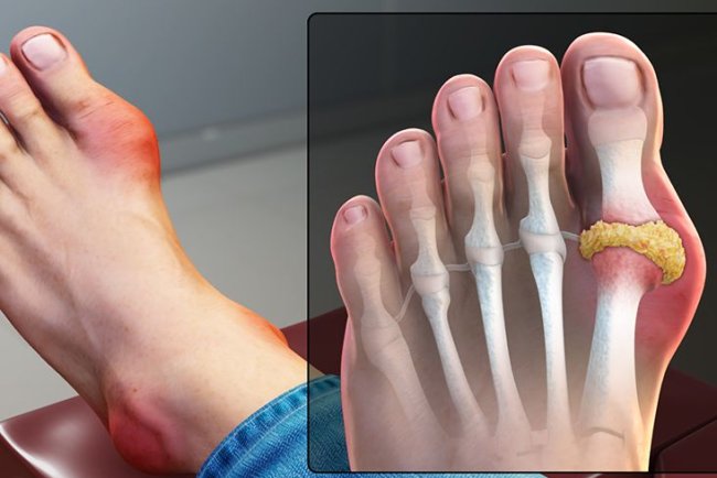How do big toe joint problems occur and what measures can be taken to avoid them.