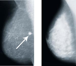 Dense Breasts on a Mammogram: What It Means and What You Can Do