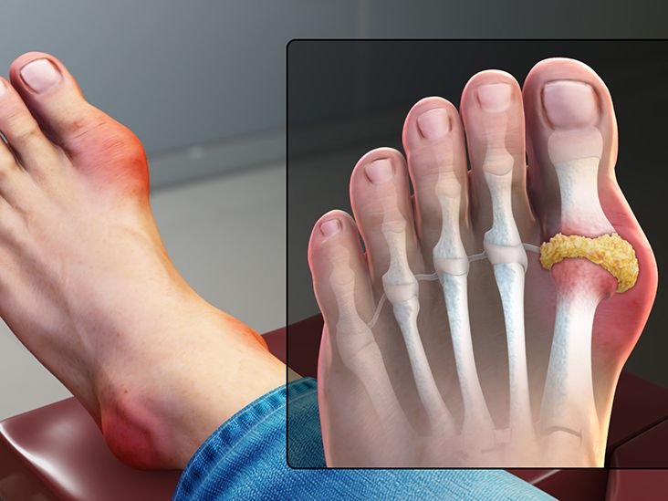 How do big toe joint problems occur and what measures can be taken to avoid them.