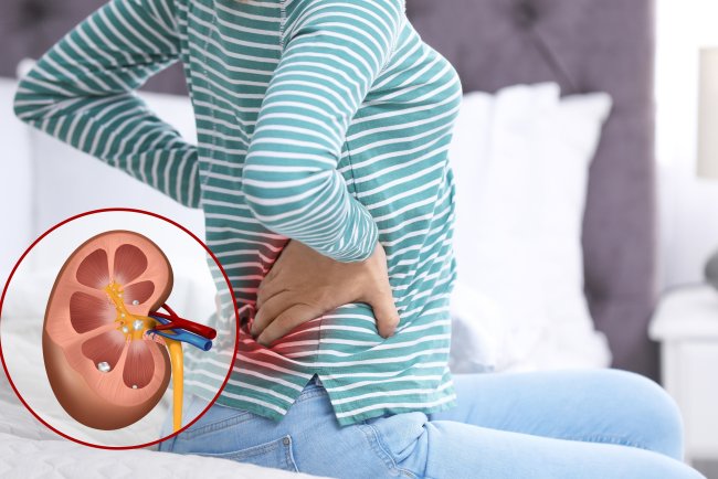 How to Pass a Kidney Stone & 5 Smart Tips to Prevent Them