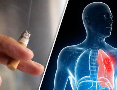 Smoking and Prostate Cancer: Why Lighting Up Could Make the Disease Deadlier