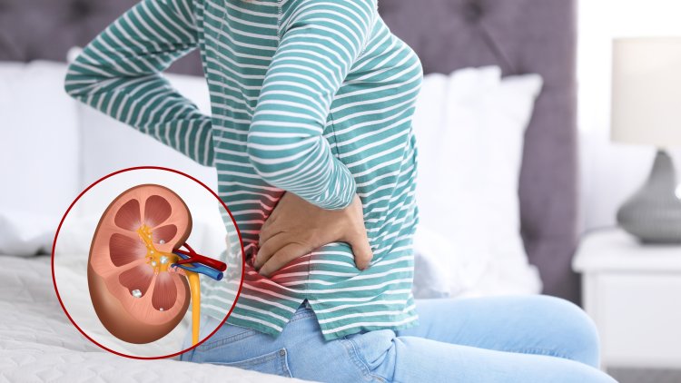 How to Pass a Kidney Stone & 5 Smart Tips to Prevent Them